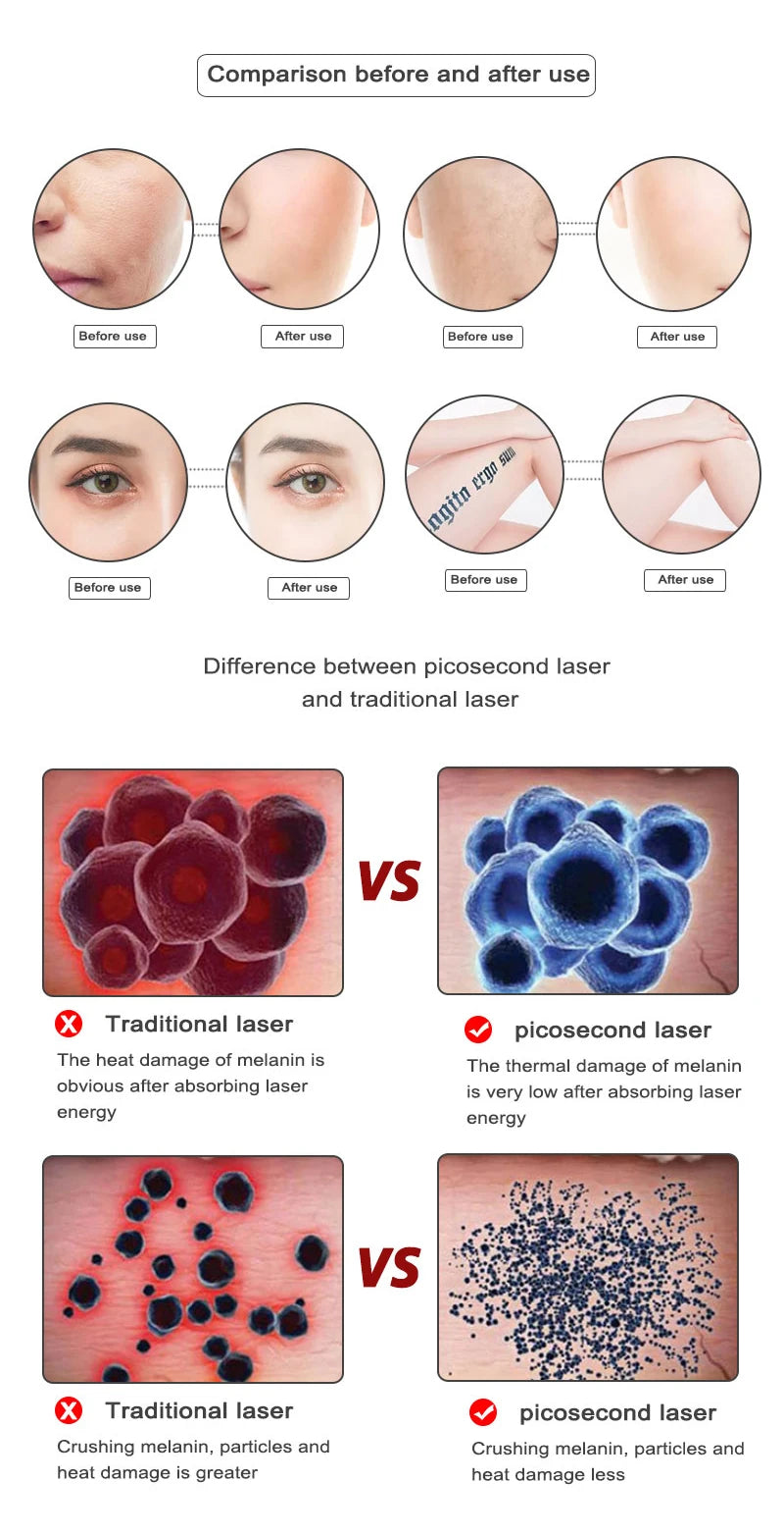 Picosecond Laser Pointer for Mole Removal Dark Spot Removal Pen Tattoo Acne Skin Pigment Portable Removal Machine Beauty Device