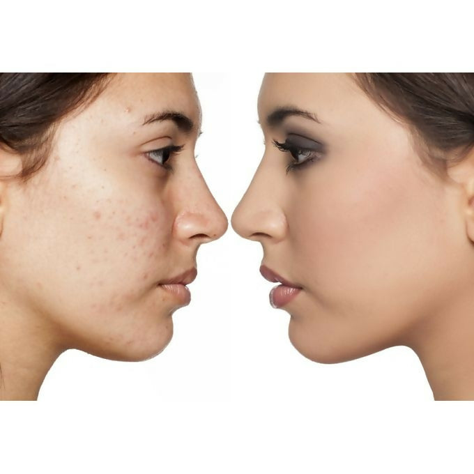 Luron Pimple Cream