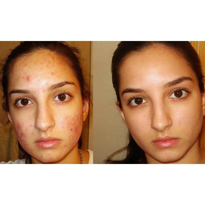 Luron Pimple Cream