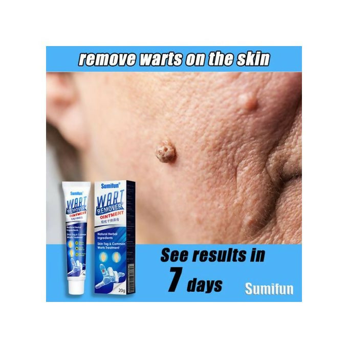 Warts Remover Ointment Warts Remover