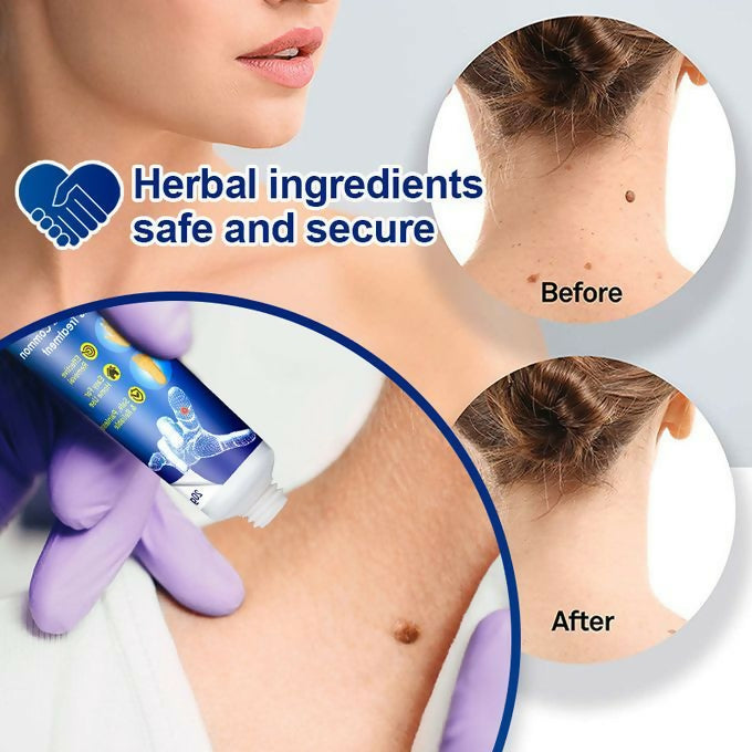 Warts Remover Ointment Warts Remover